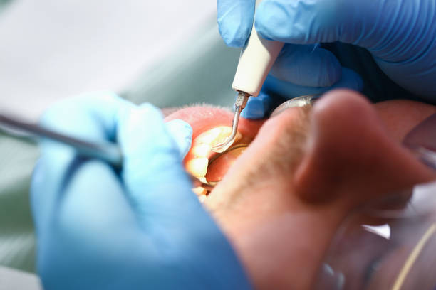 Best Emergency Dental Extractions in Big Bear Lake, CA